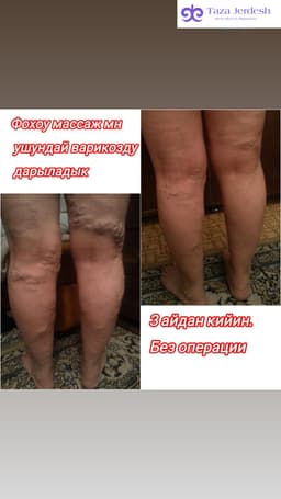 хиджама, массажа,пиявки.